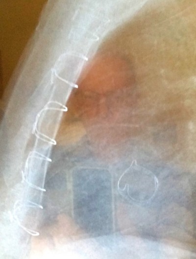 Heart Valve 400p